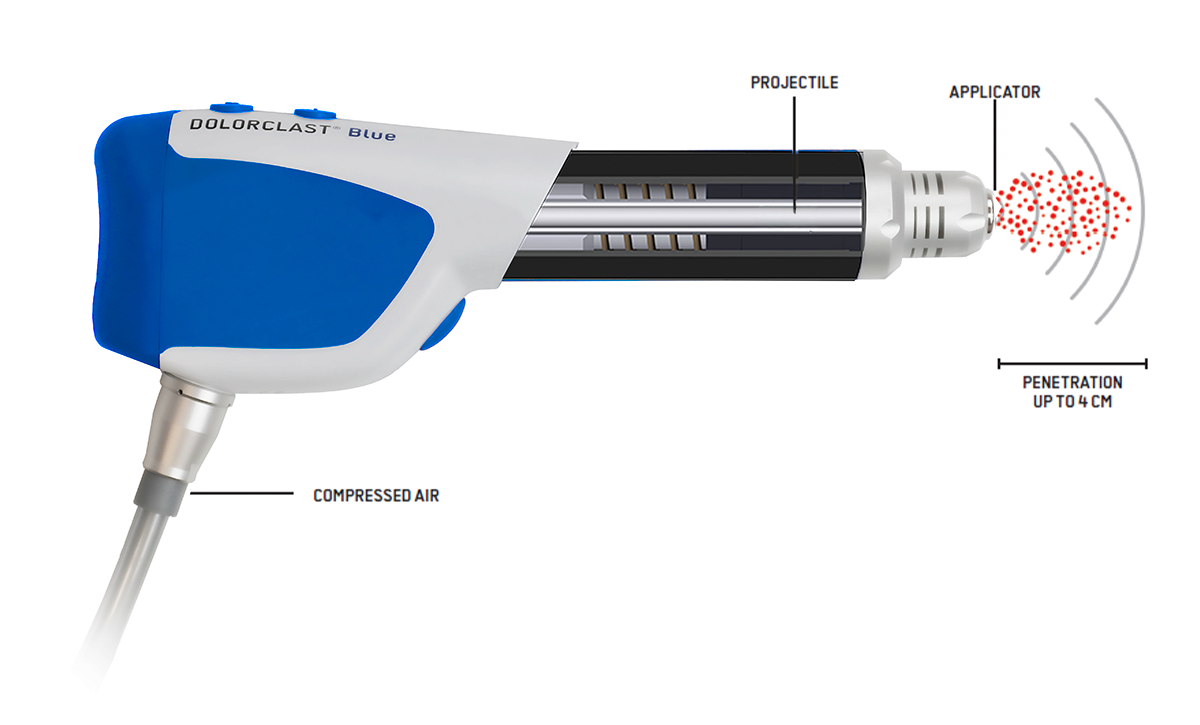 dolorclast radial blue handpiece
